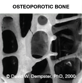 abnormal bone