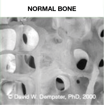 normal bone